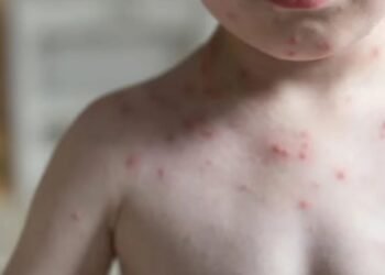 El sarampión “vuela” en Quintana Roo, el estado supera el 2% de la tasa de incidencia en contagios