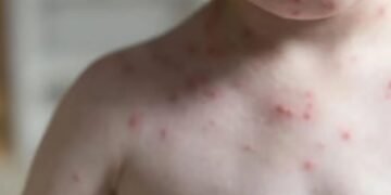 El sarampión “vuela” en Quintana Roo, el estado supera el 2% de la tasa de incidencia en contagios