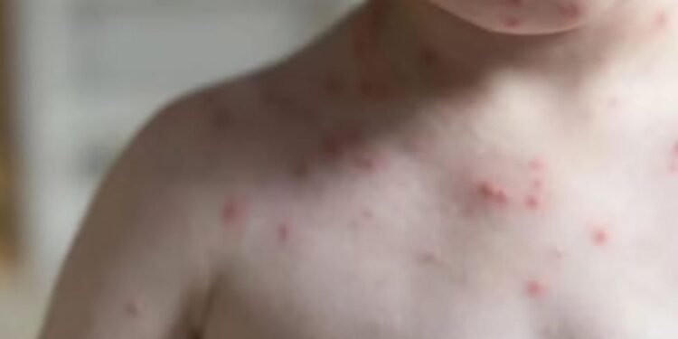 El sarampión “vuela” en Quintana Roo, el estado supera el 2% de la tasa de incidencia en contagios