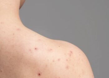 ¿Erupciones y fiebre? Podría ser varicela: esto debes saber
