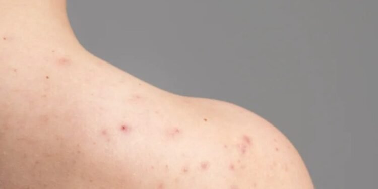 ¿Erupciones y fiebre? Podría ser varicela: esto debes saber